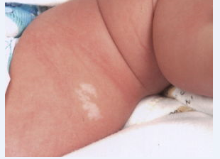 婴儿手部白癜风应该如何治疗