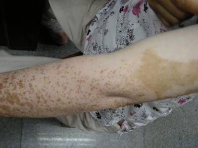 成人肢端型白斑病如何正确治疗